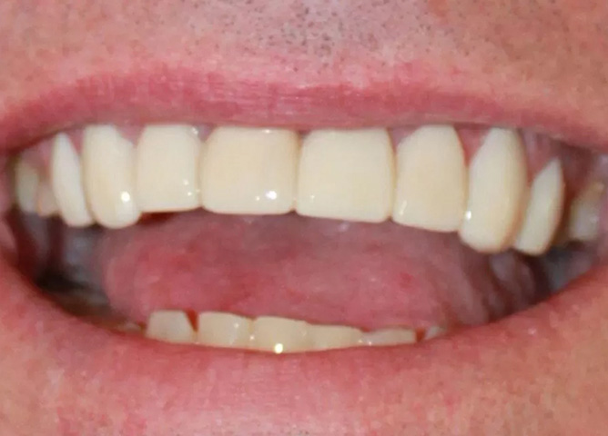 after lumineer case