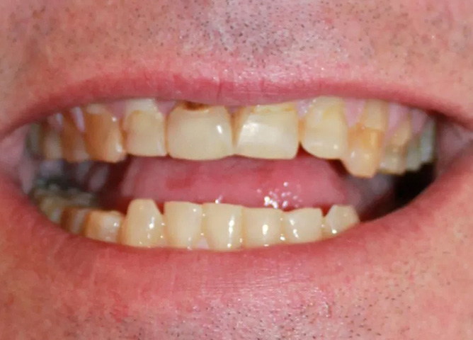 before lumineer treatment