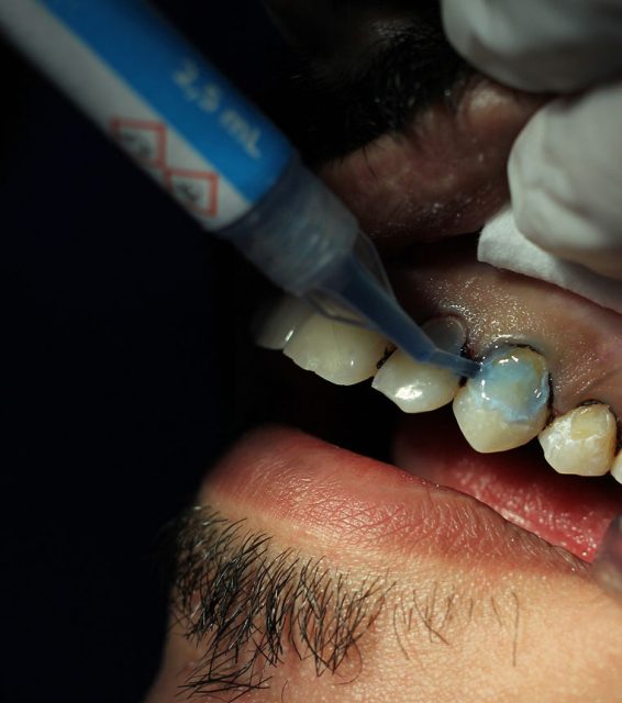 dental bonding treatment process
