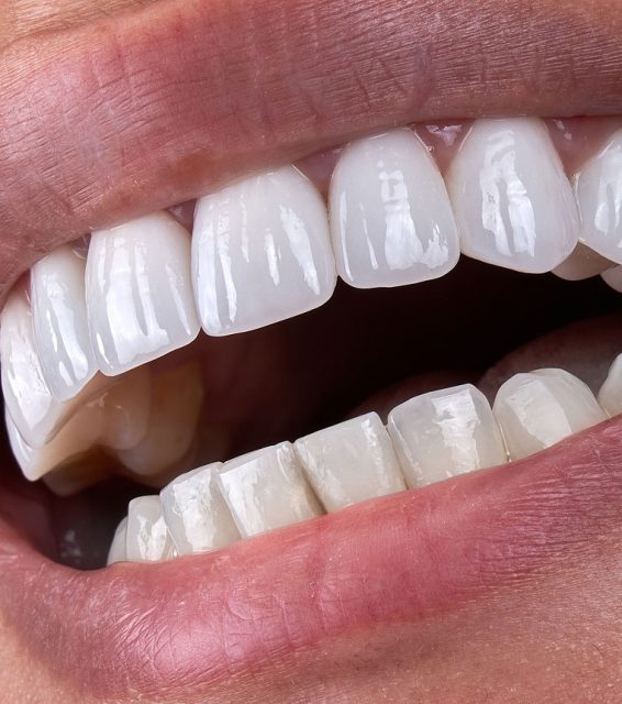 after teeth whitening treatment results
