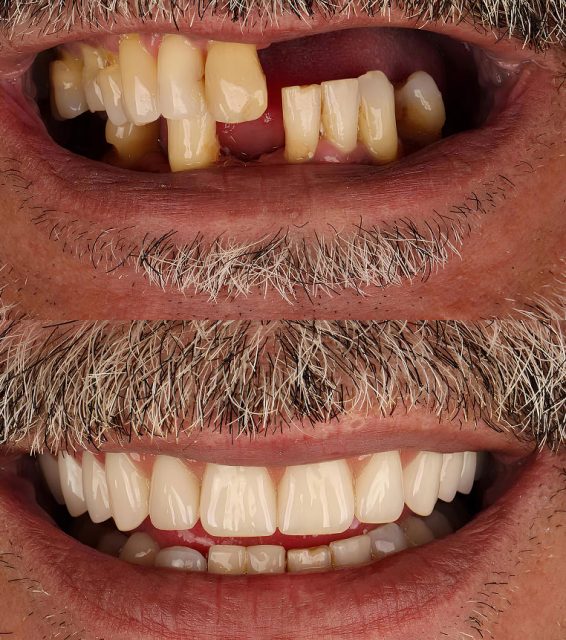 before and after full mouth rehabilitation case from Nash Dental Group - cosmetic dentist near you