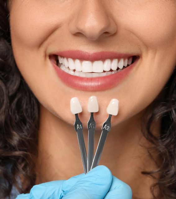 three porcelain veneers shades