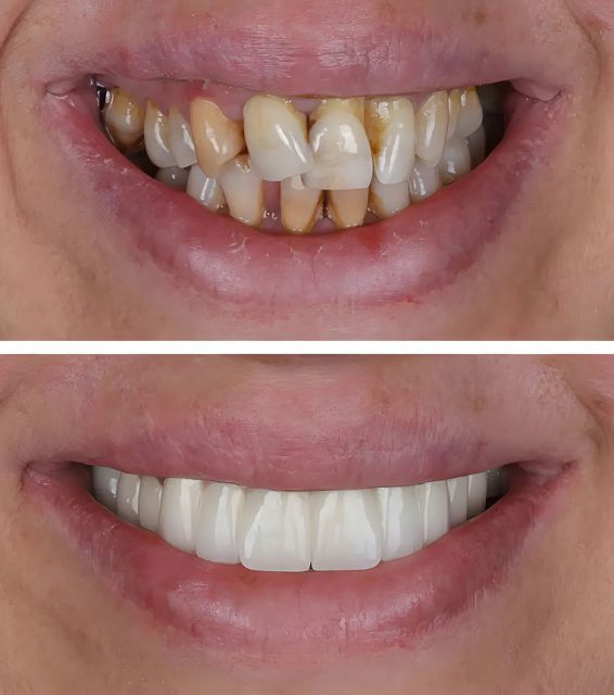 before and after smile makeover case from Nash Dental Group - cosmetic dentist near you