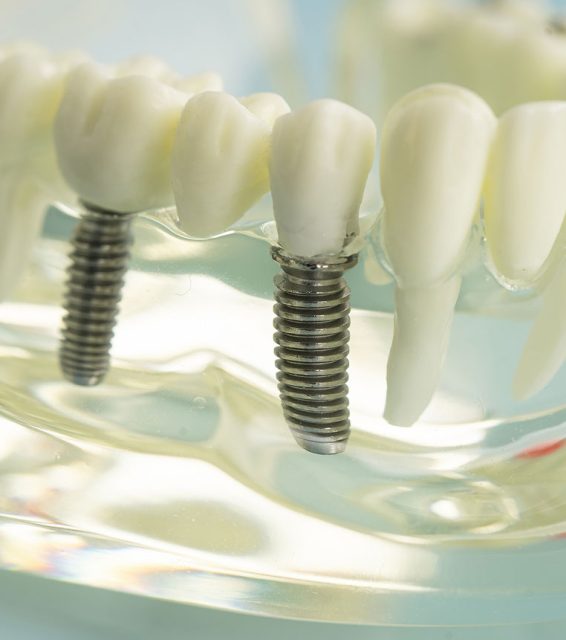dental implants near you