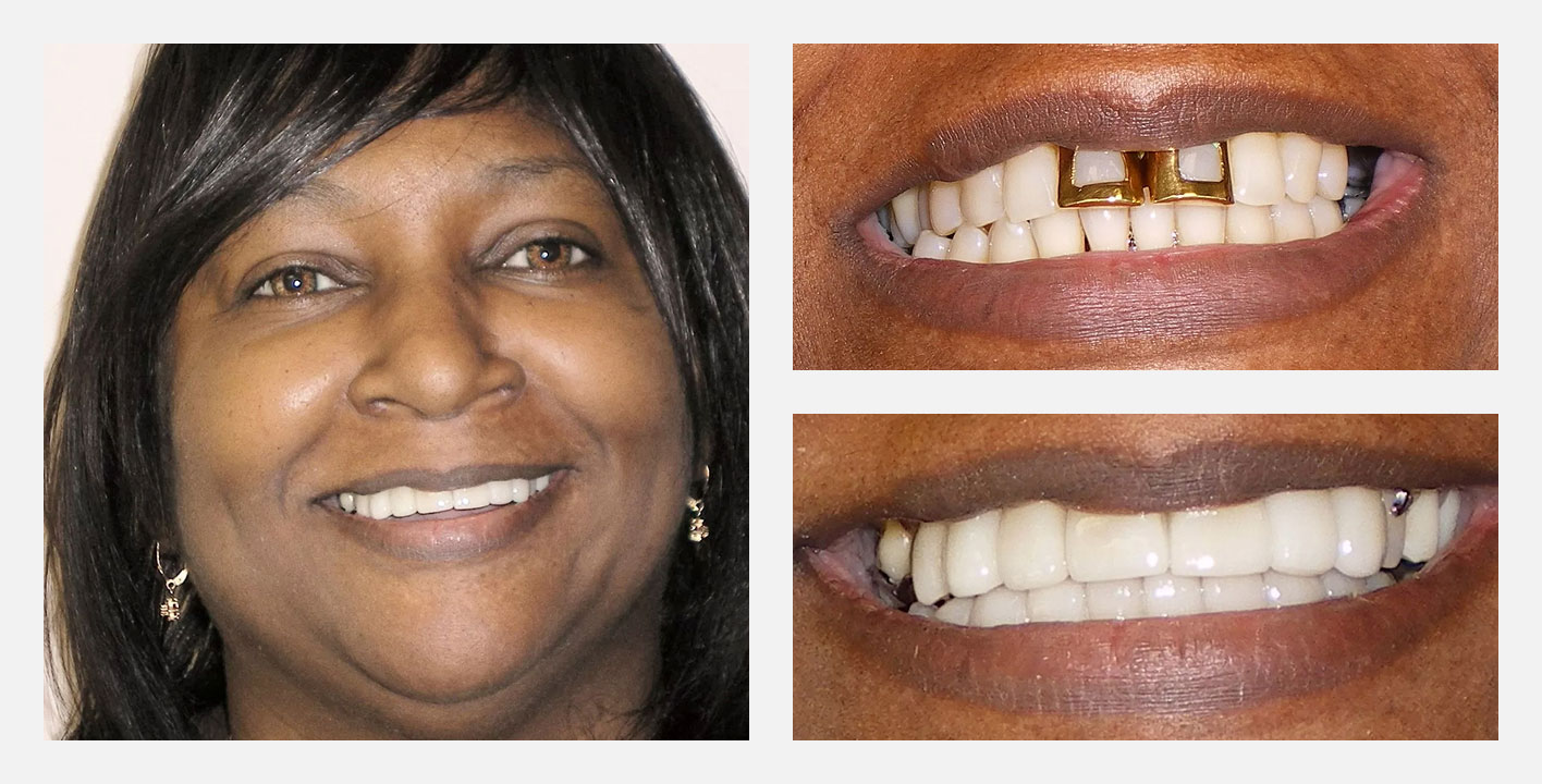 smile makeover case, replacing the two upper front teeth from Nash Dental Group - cosmetic dentist near you