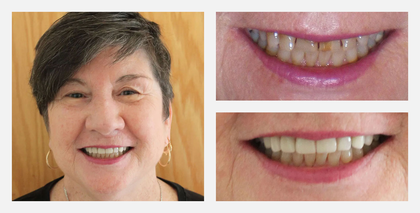 before and after smile makeover case from Nash Dental Group - cosmetic dentist near you