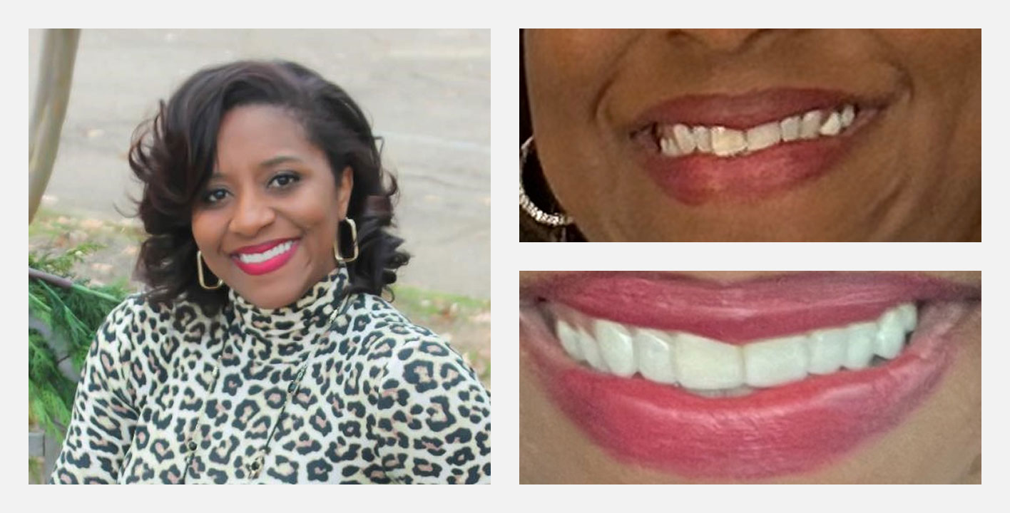 smile makeover case from Nash Dental Group - cosmetic dentist near you