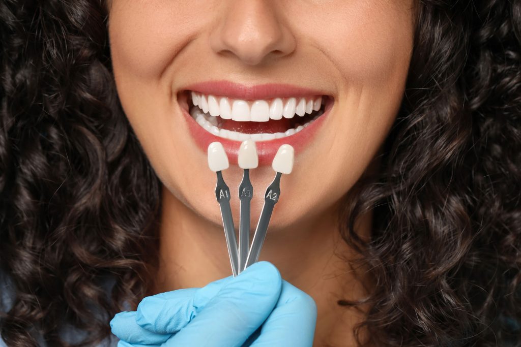 porcelain veneer shades in front of a patient's mouth to determine the right shade